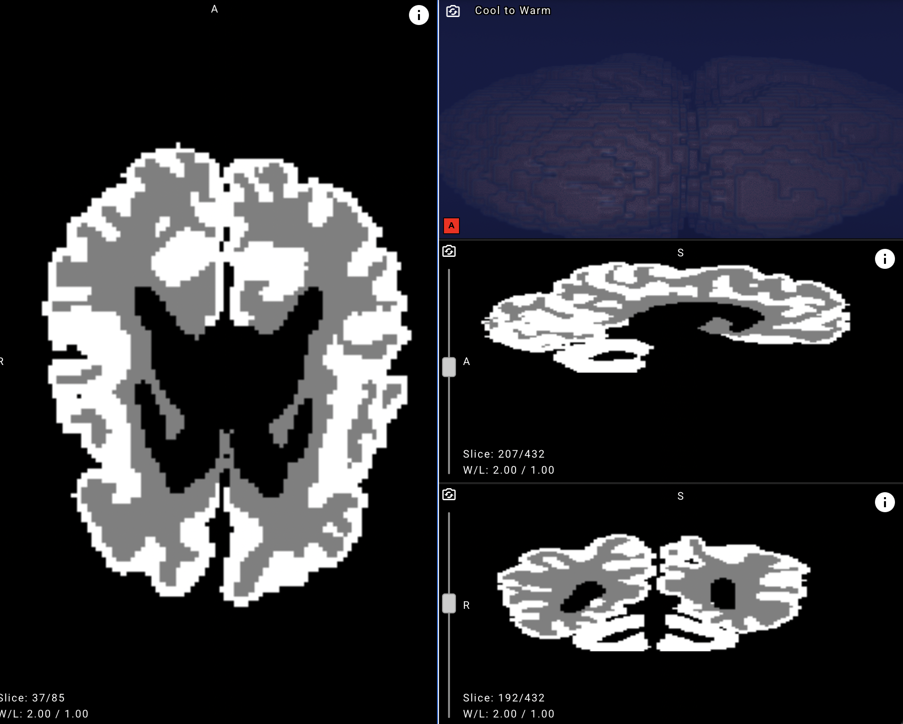 Белорусские врачи смогут точнее выявлять ДЦП у новорожденных с помощью нейросети